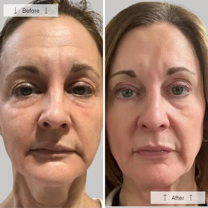 Omnilux Contour LED Face Mask
